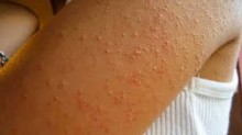1.400 casos de escabiosis reportó Salud Miranda en primer tr...